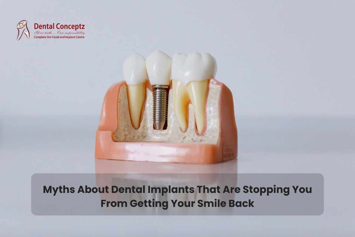 Dental Implant Myths