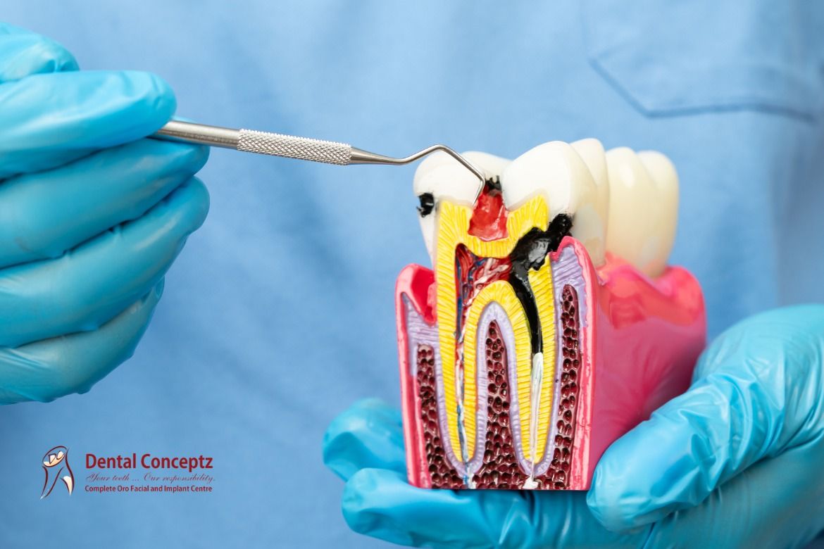 Root Canal