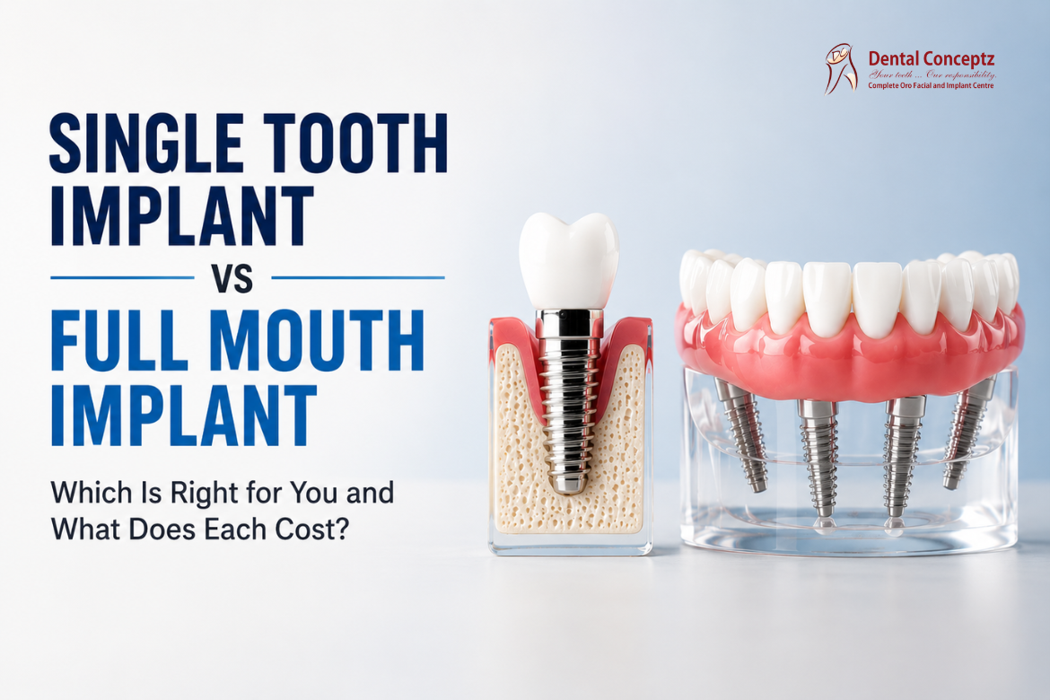 Single Tooth Implant vs Full Mouth Implant