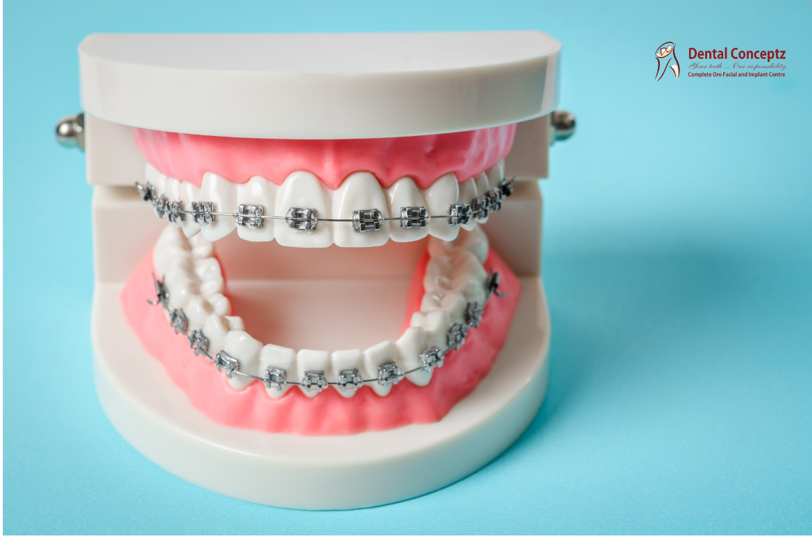 Dental Braces