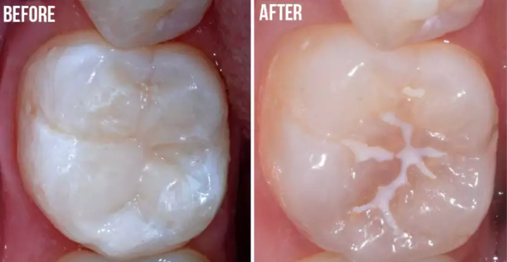 Sealants
